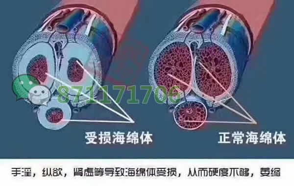 nbb修复膏可以修复海绵体吗 